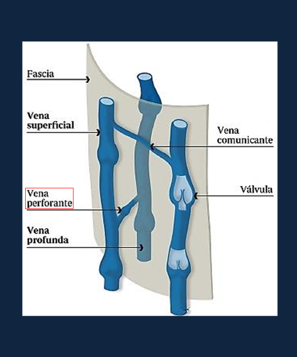 gemelo Mucama borracho Ligadura de Perforantes - Atención Vascular : Tratamiento de Várices,  Ulceras, Pie Diábetico en Monterrey